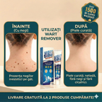 Wart Remover - Tratament Natural Anti-Negi